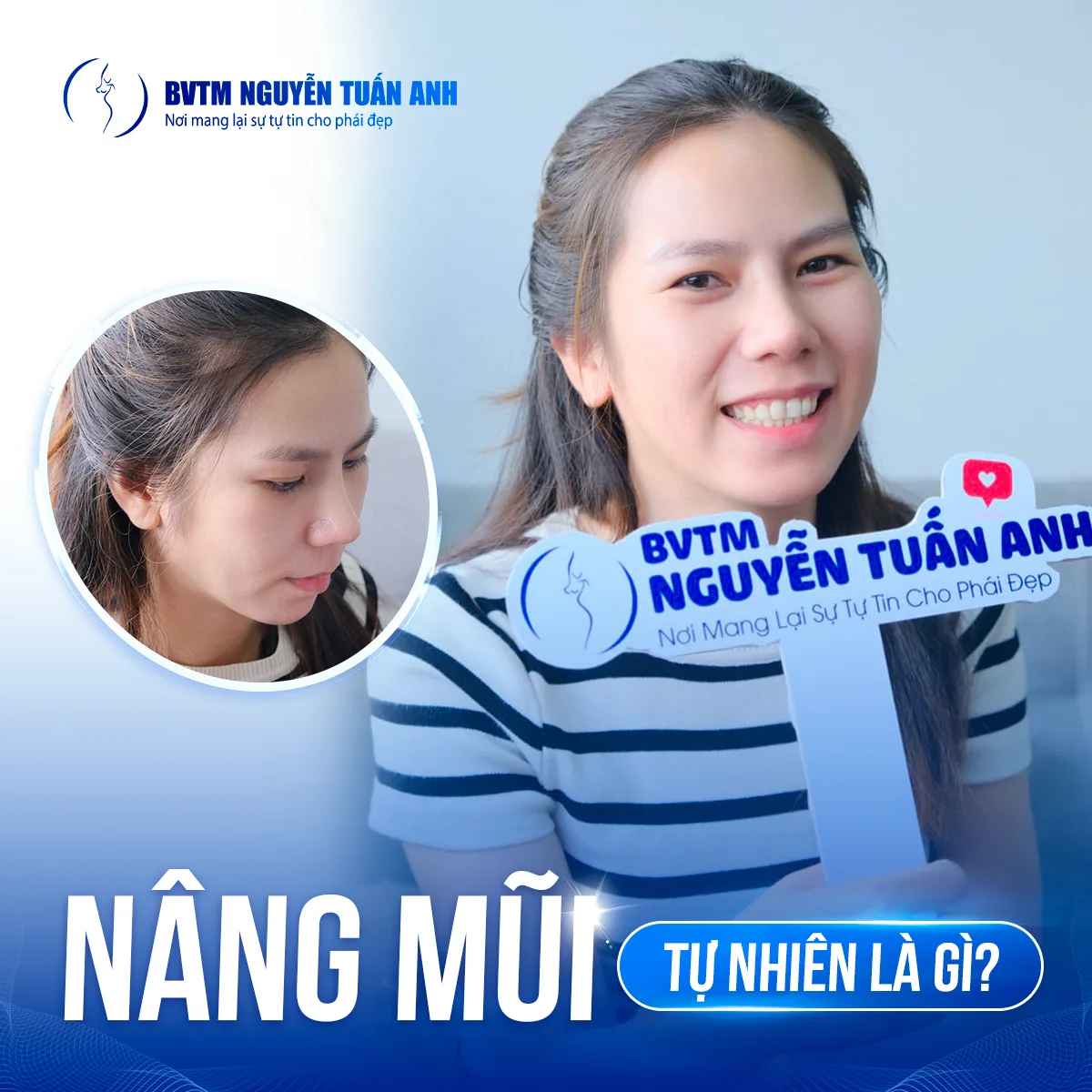 Kỹ thuật nâng mũi tự nhiên là như thế nào?