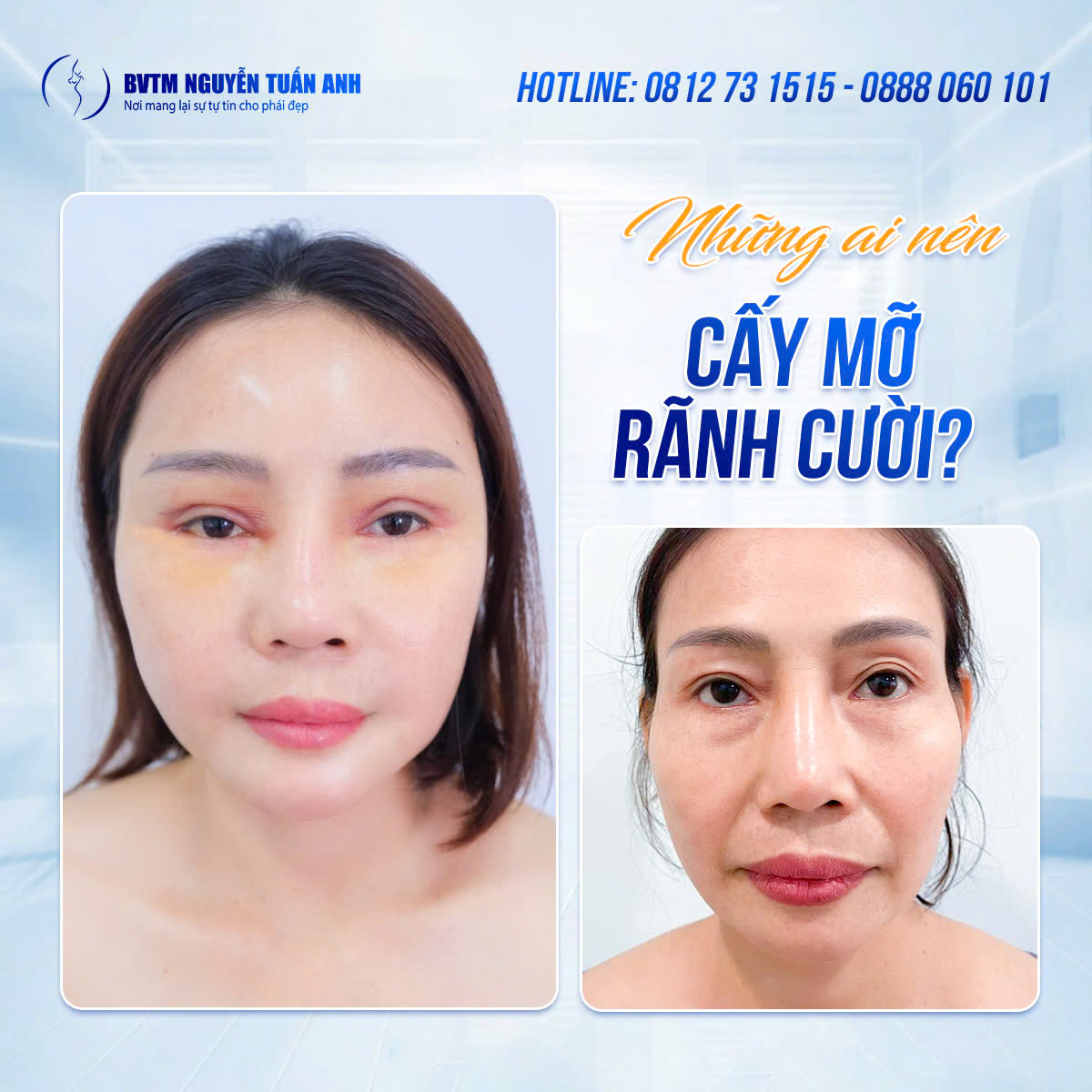 Cấy mỡ rãnh cười là gì? Phương pháp thực hiện ra sao