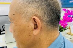 Máy trợ thính làm theo khuôn tai sẽ trông như thế nào?