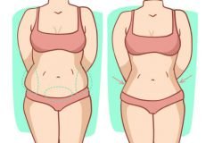 Hút mỡ bị lồi lõm có chỉnh sửa được không?