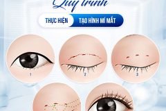 Giải pháp tạo nếp mí tự nhiên cho người bận rộn