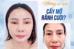 Cấy mỡ rãnh cười là gì? Phương pháp thực hiện ra sao