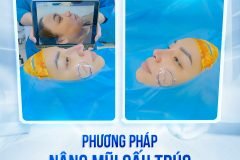 Nâng Mũi Sụn Tai Có Gây Nguy Hiểm Không