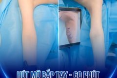 Cánh tay to thô hết lo với giải pháp hút mỡ Lipo
