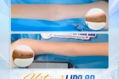 Phẫu thuật hút mỡ sau bao lâu thì sẽ hết sưng và bầm?