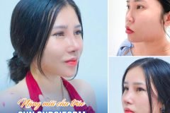 Nâng mũi cấu trúc sụn surgiform
