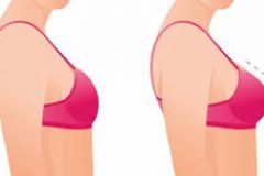 Hành trình hồi phục sau nâng ngực