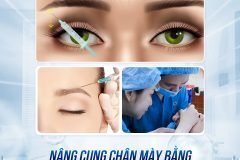 Nâng cung chân mày bằng botox