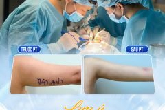 Hút mỡ cánh tay có an toàn và hiệu quả lâu dài không?
