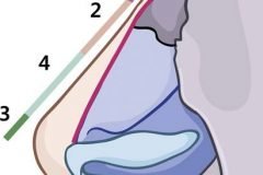 Mũi lộ sóng sau phẫu thì cần sử dụng phương pháp nào?