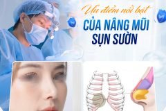 Nâng mũi sụn sườn có bền lâu không