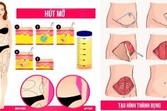 Tạo hình thành bụng khác gì hút mỡ bụng?