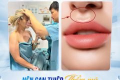 Nhân trung sâu dài nói lên điều gì