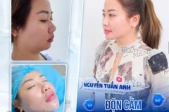 Độn cằm sụn surgiform
