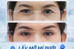 Lấy Mỡ Mí Dưới Có Làm Vùng Mắt Sáng Hơn Không?