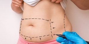 Da chùng khi hút mỡ là đúng hay sai
