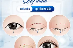 Giải pháp tạo nếp mí tự nhiên cho người bận rộn tại TP. Hồ Chí Minh