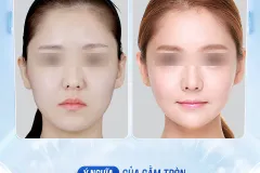 Cằm tròn đầy - Biểu tượng thẩm mỹ tại TP.HCM