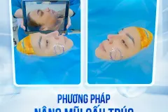 Nâng mũi sụn tai an toàn tại TP. Hồ Chí Minh