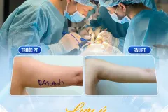 Hút mỡ cánh tay an toàn tại TP.HCM