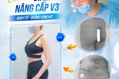 Combo giảm mỡ và nâng cấp vòng 3 tại TP.HCM