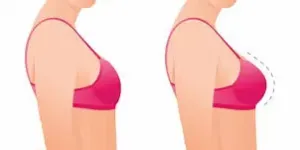 Hành trình hồi phục sau nâng ngực tại TP.HCM